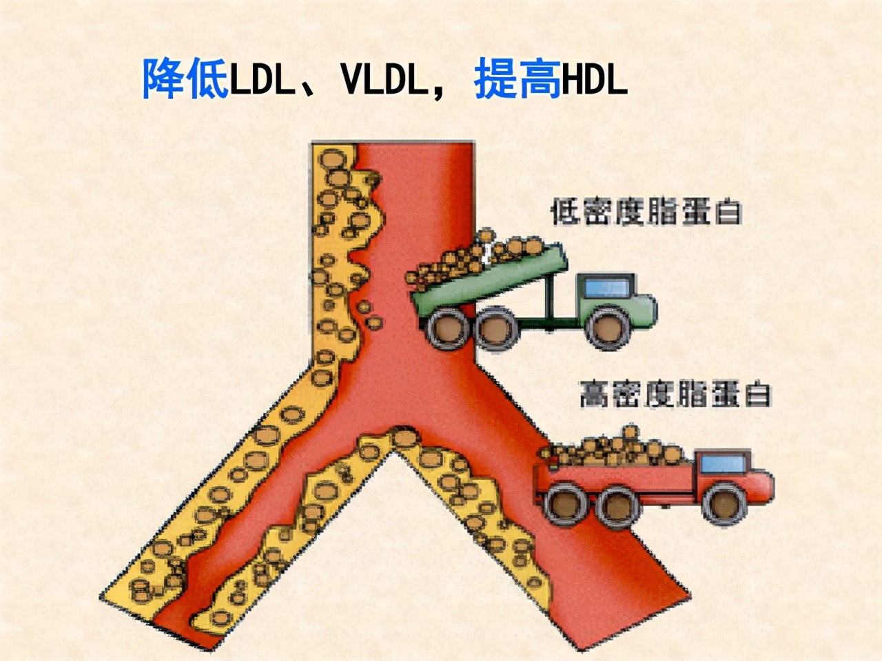 低密度脂蛋白胆固醇:要低于多少斑块才能不发展?