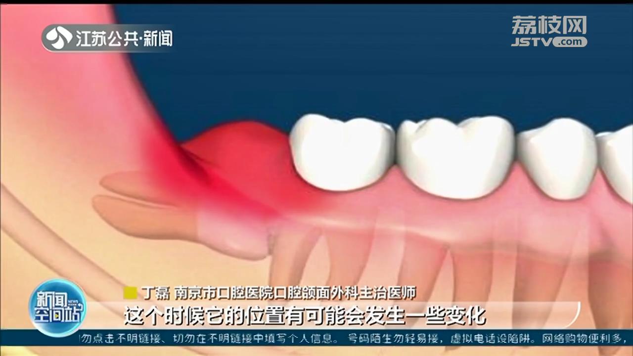 扬州女子智齿发炎硬扛好几年，左侧脸颊被脓肿穿破 智齿一定要拔吗？