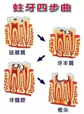 自查蛀牙的方法，你知道吗？