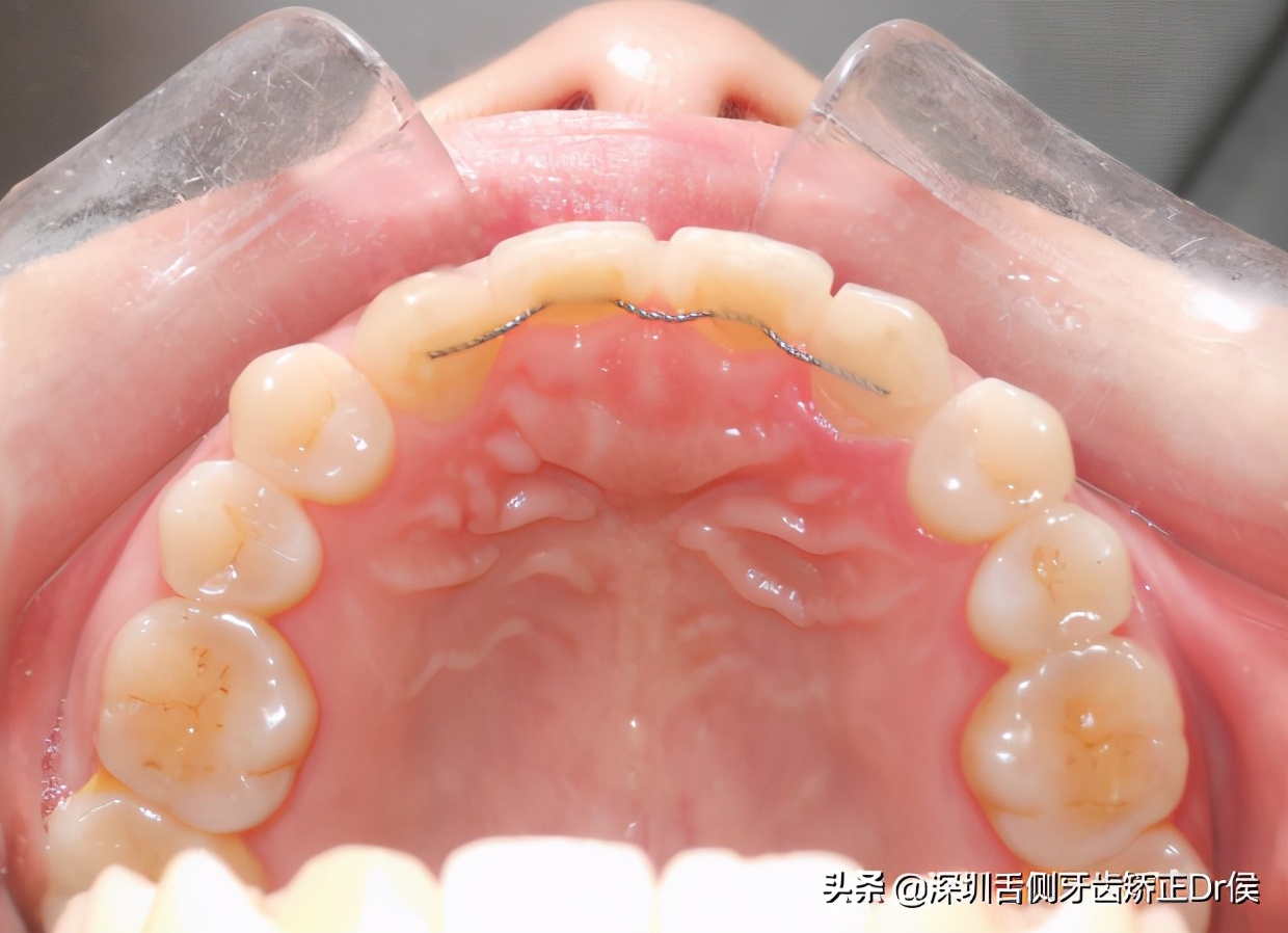 舌侧保持器价格别说我没告诉你