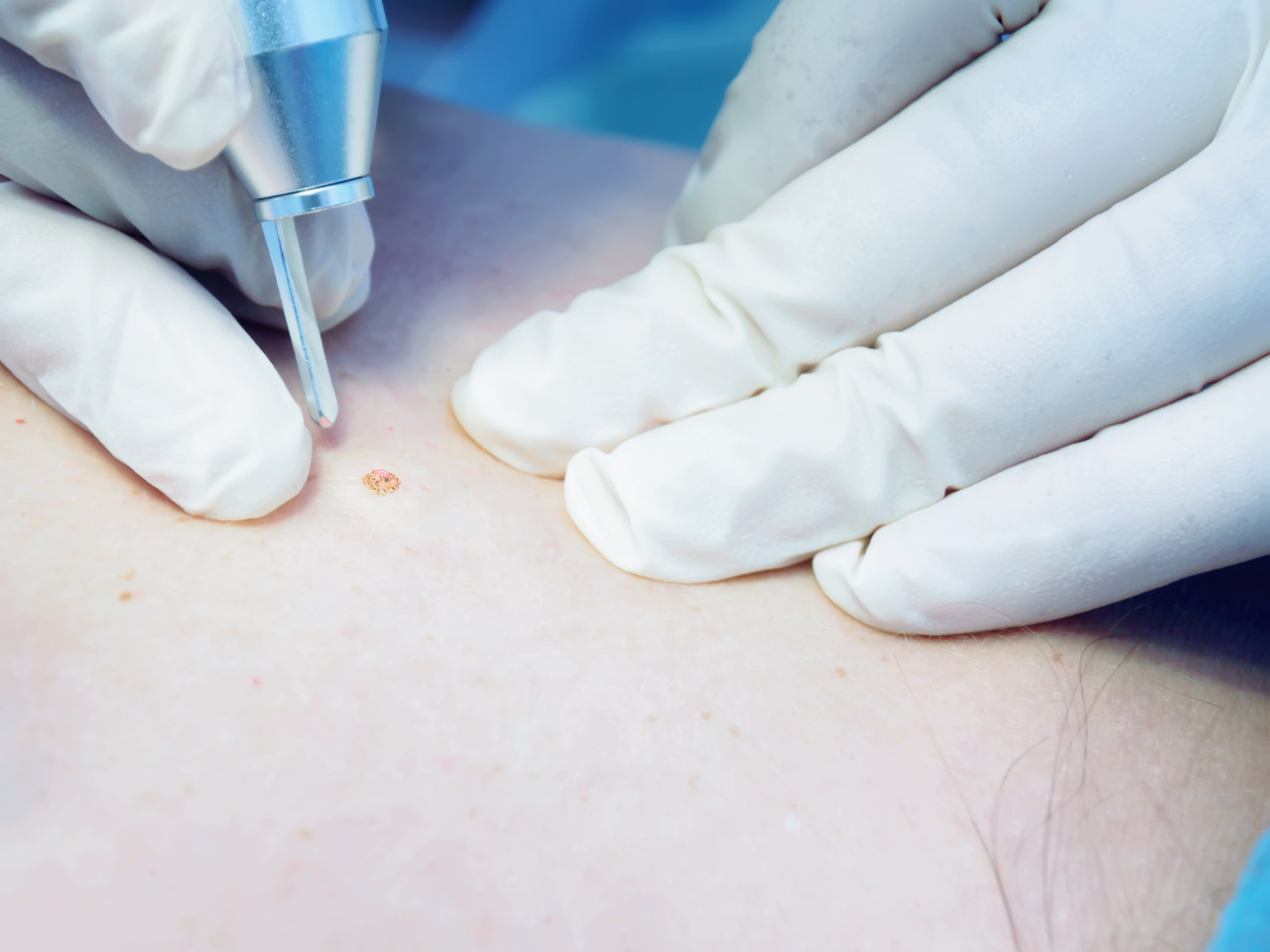 皮肤上的小肉球、小肉疙瘩是什么？不出意外，这4种可能性较大