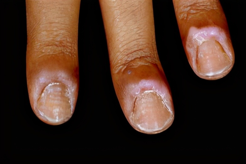 指甲没剪对,宝宝的手竟变成这样