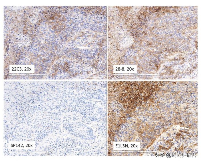 PD-L1检测里的门道：不同的检测标准，最终结果可能完全不同