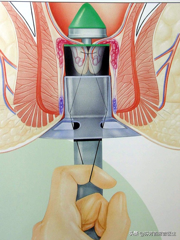 痔疮发作要做手术，到底是传统手术好，还是选择PPH手术？