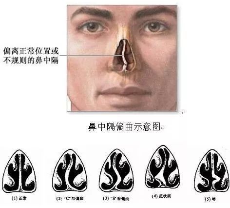 小S做的这个小手术，听说能治好鼻炎！靠谱吗？