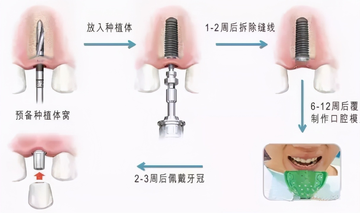 拔牙后多久可以种牙(拔牙后最晚多久可以种植牙)-骁龙网