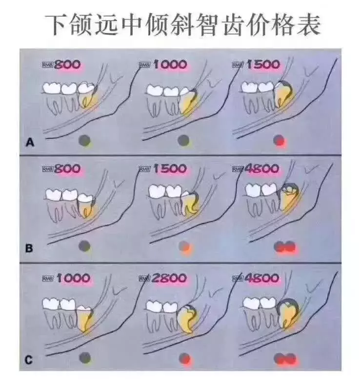 一起去拔智齿，为啥收费差别这么大？拔智齿按什么标准收费的？