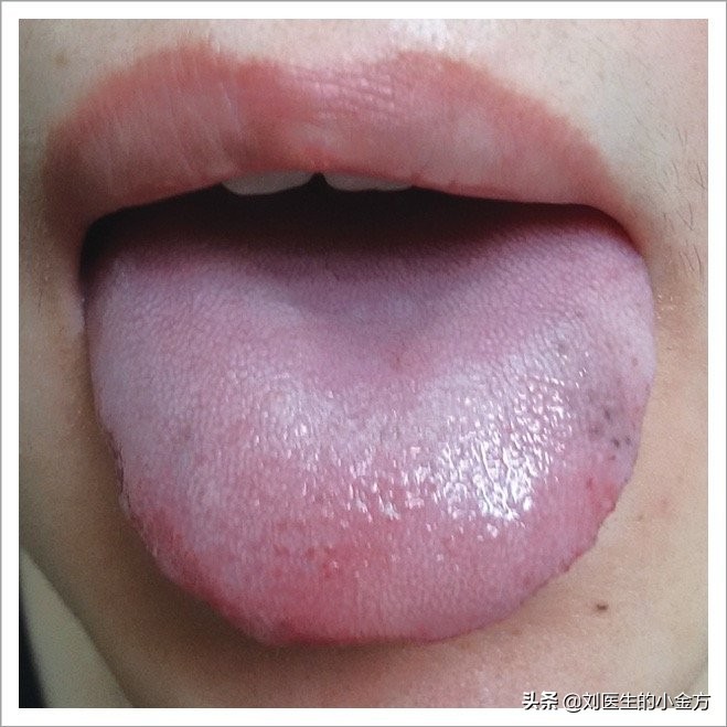 淡紫瘀点舌青紫瘀斑舌舌下络脉曲张