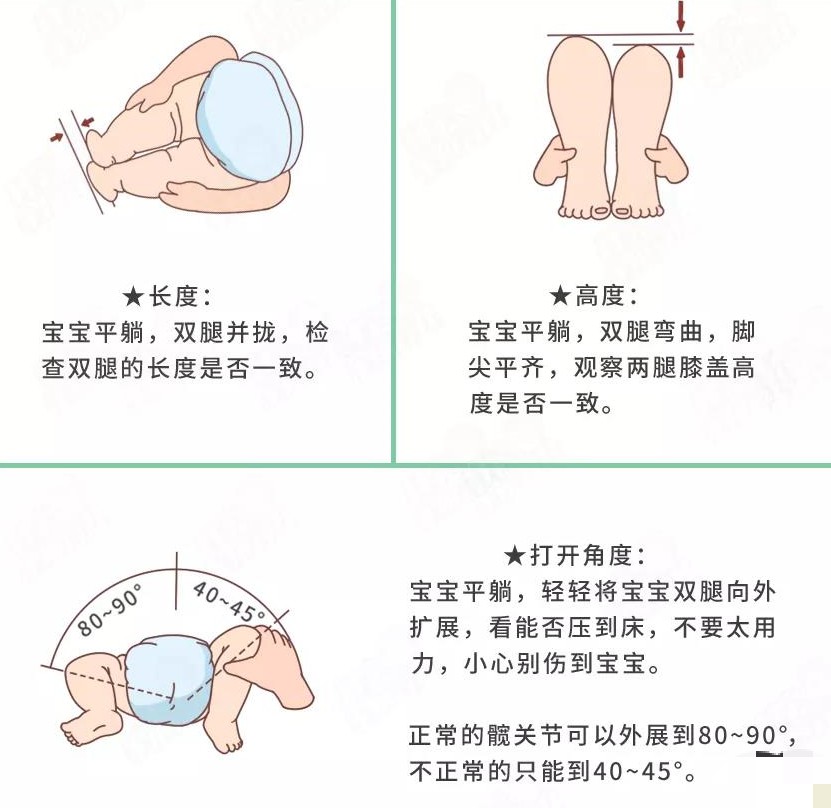 宝宝腿纹不对称,难道是髋关节发育不良