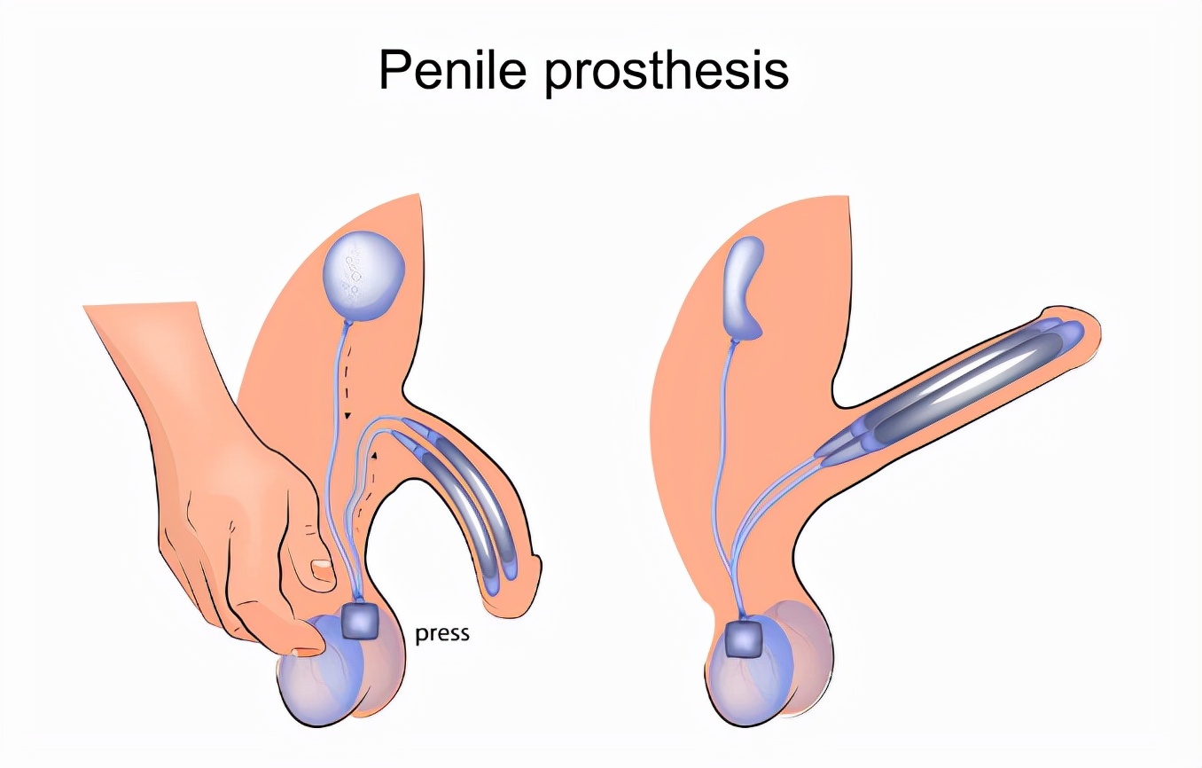 28岁青年接受阴茎起搏器植入手术,植入假体后,和正常人一样吗?