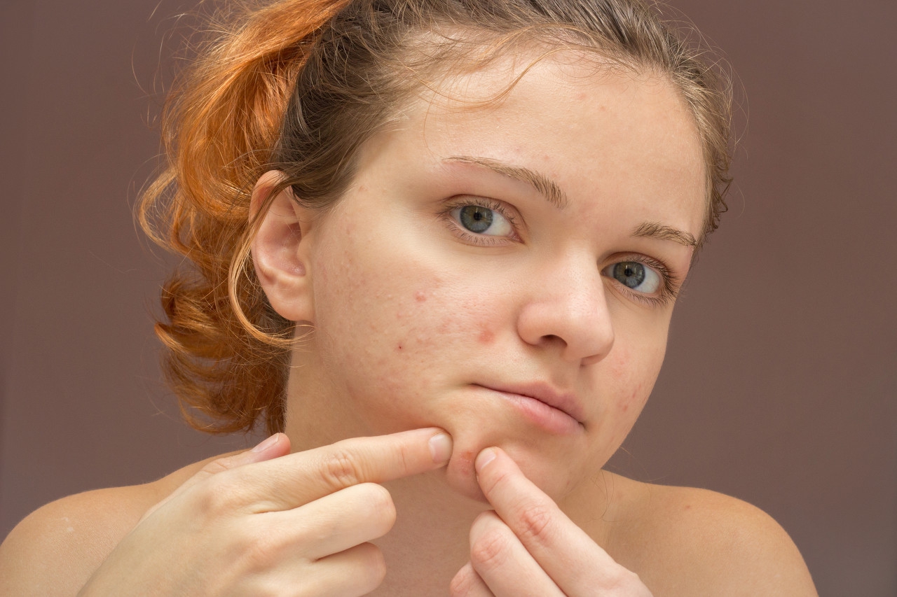 脸上的红痘印怎么去除？6个方法最有效，帮你快速去除脸上红痘印