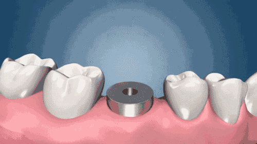 不同人群，缺牙装牙，活动假牙VS固定假牙，到底怎么选？