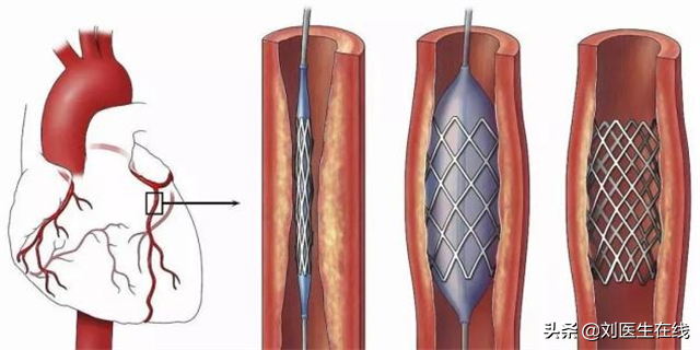 支架对心脏病患者来说，究竟是好是坏？医生说了句公道话