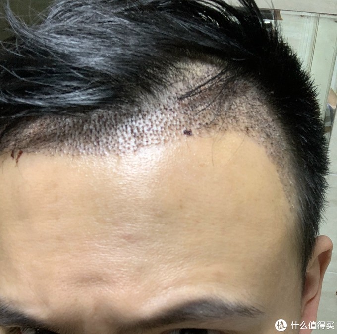 中年男人的倔强,m型头的自我拯救——植发体验