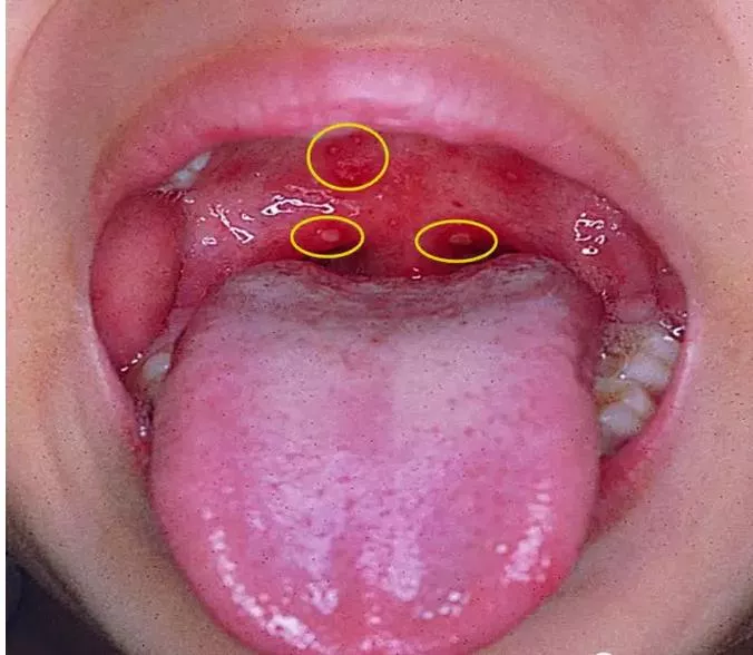 幼儿喉咙有疱疹图片