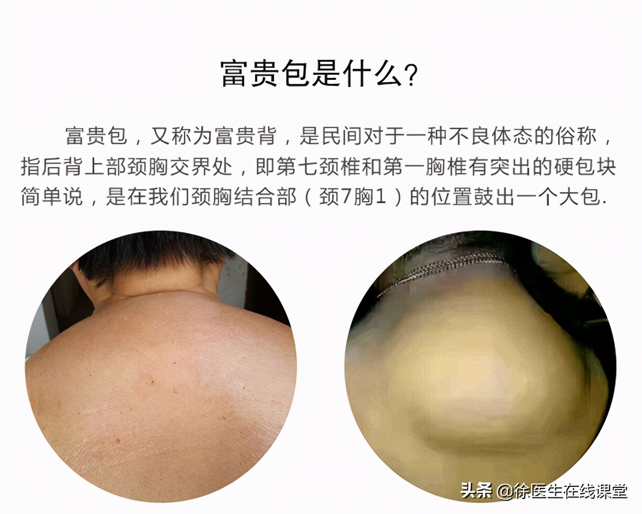 脖子上长“富贵包”，其实是患了颈椎病！教你三个动作消除富贵包