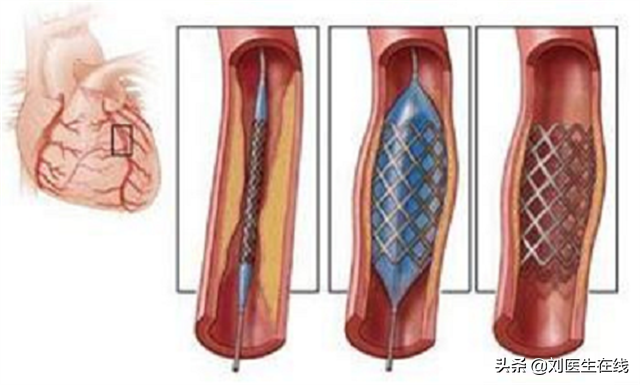 支架对心脏病患者来说，究竟是好是坏？医生说了句公道话