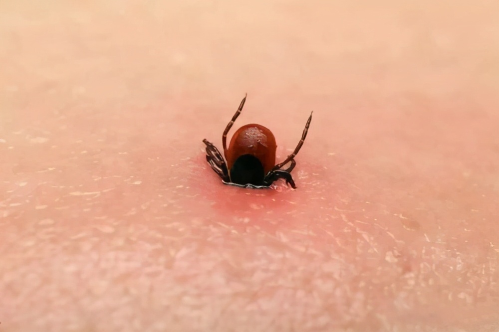 出生仅4天的婴儿被蜱虫咬伤,遇到这种"毒虫",我们该怎么办?