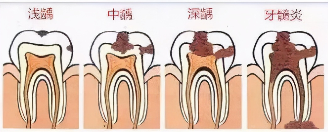 小小一颗龋齿，引来“癌”？你还在拿虫洞当小问题吗