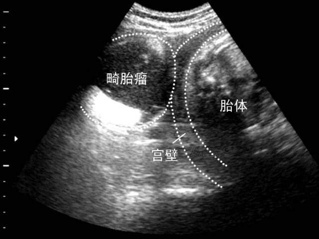 畸胎瘤该怎么办？