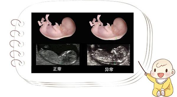 孕妇做NT检查也有技巧，要是做不好这4点，3次4次不通过都有可能