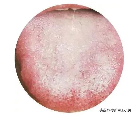 体内有湿气？4个表现帮您判断