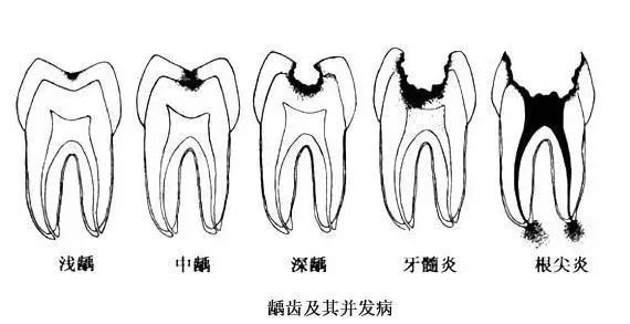 补牙要趁早！小龋坏久拖不治，最后花费上万，冤不冤？