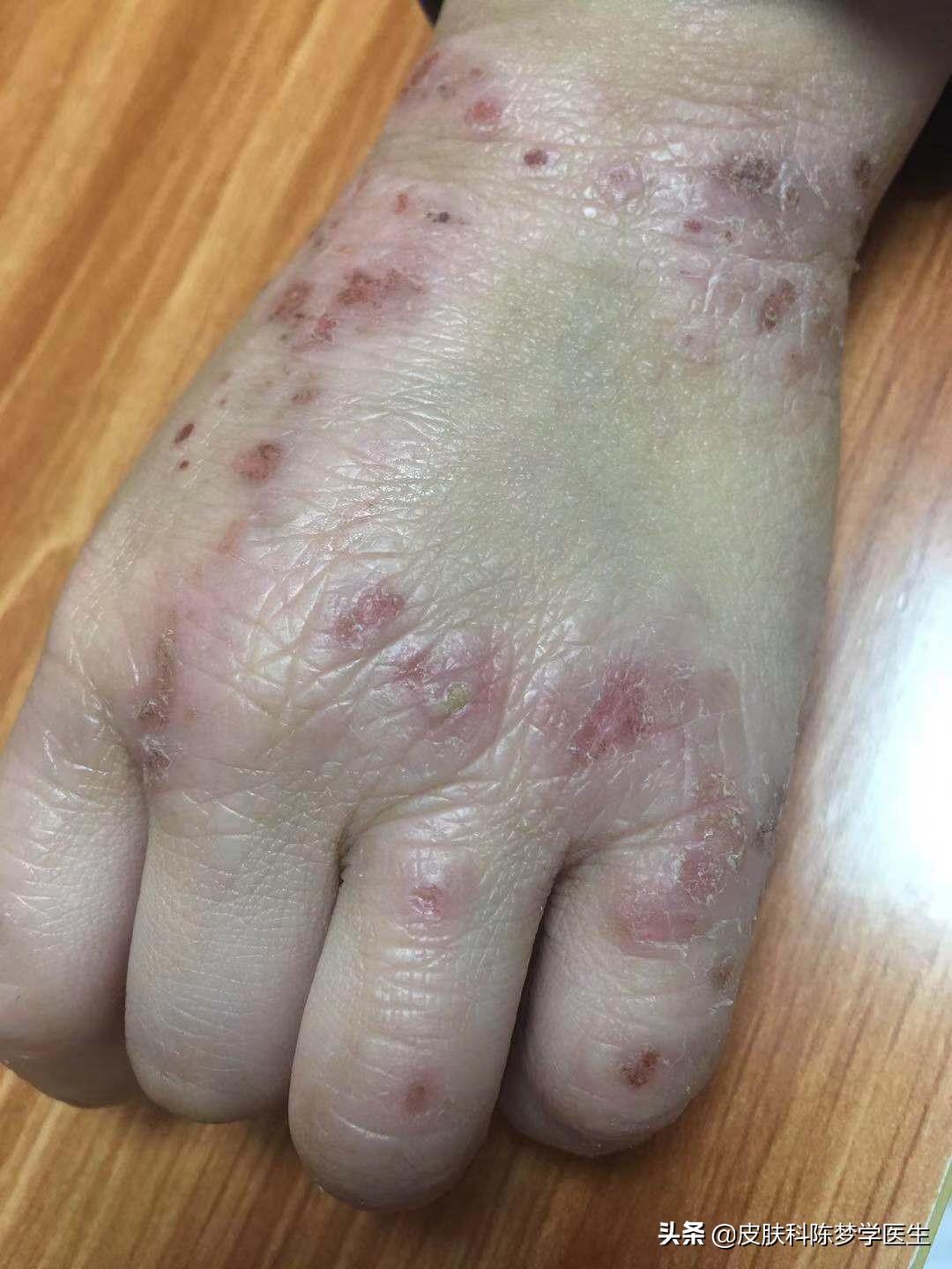 湿疹,能不能治得好?