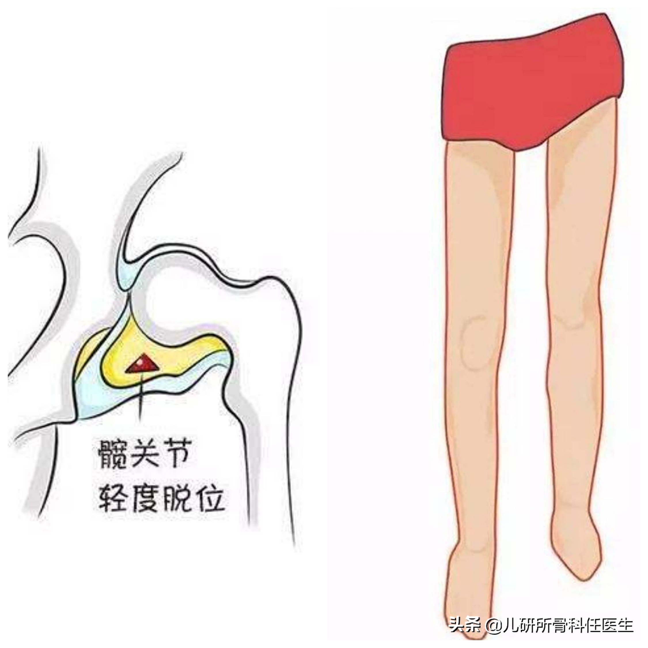 宝宝臀纹对称图片图片