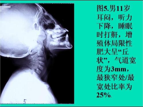 手术治疗儿童腺样体肥大，也未必一劳永逸，该怎么办？