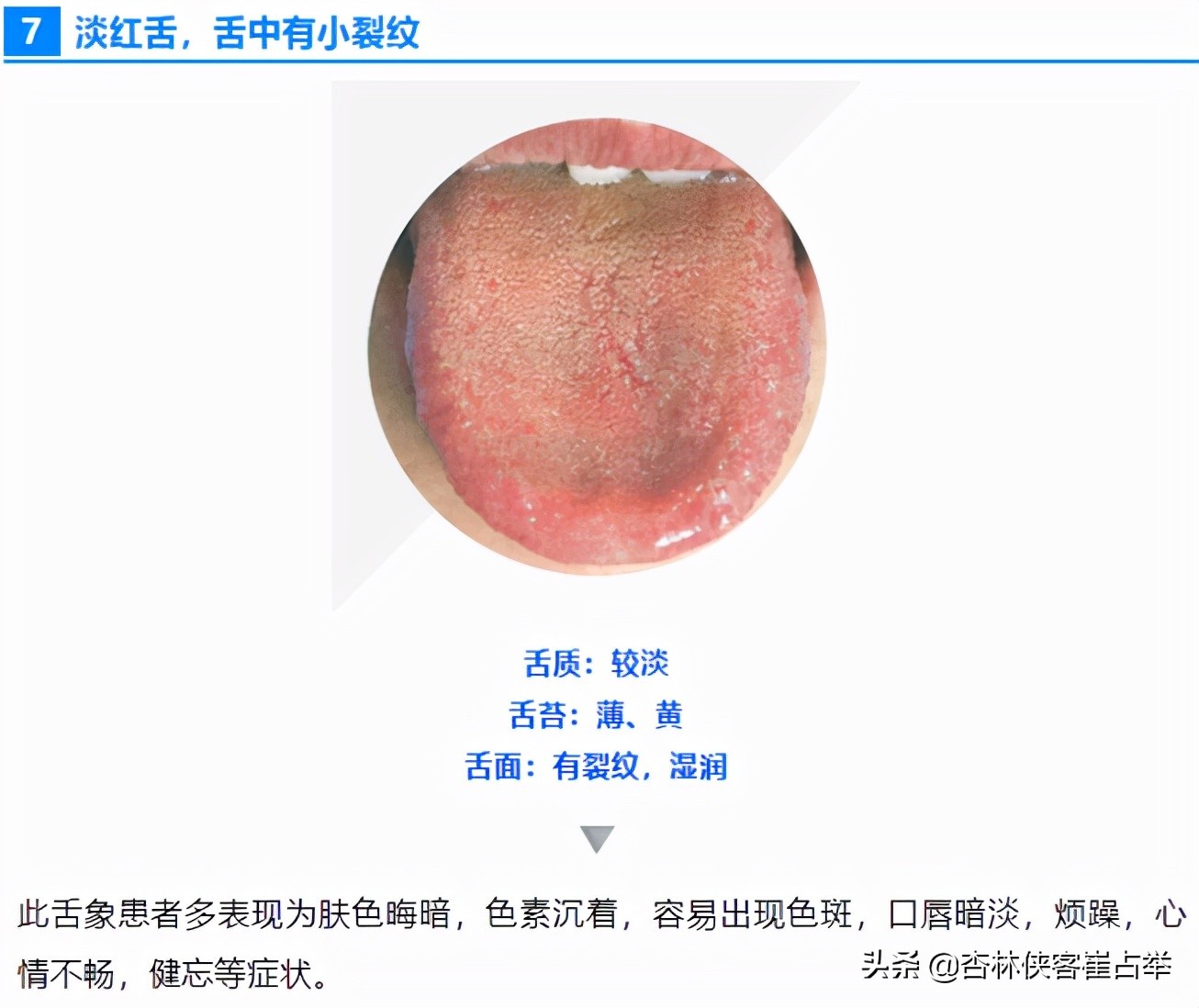 如何通过舌头，分辨心脑血管疾病、中风前兆？教你一招，快速辨别