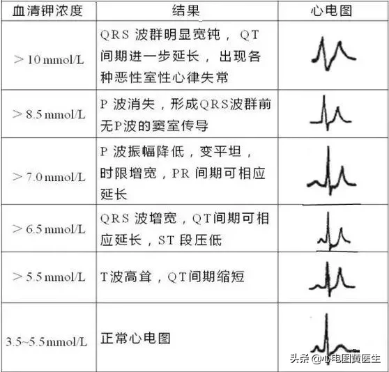 高钾血症与低钾血症心电图表现总结