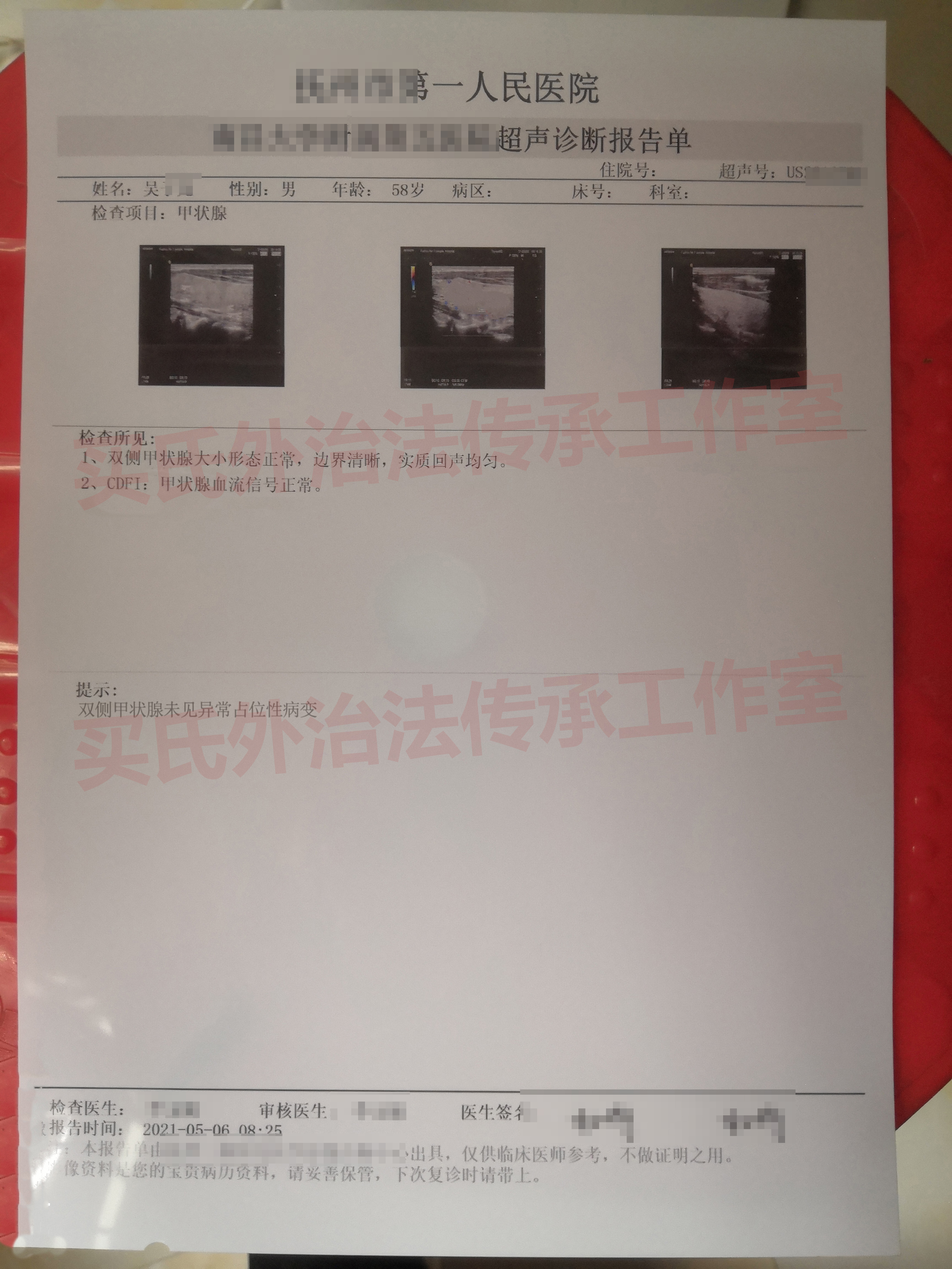 2.5公分甲状腺囊实混合回声结节，中医辨证外治内服，结节消除