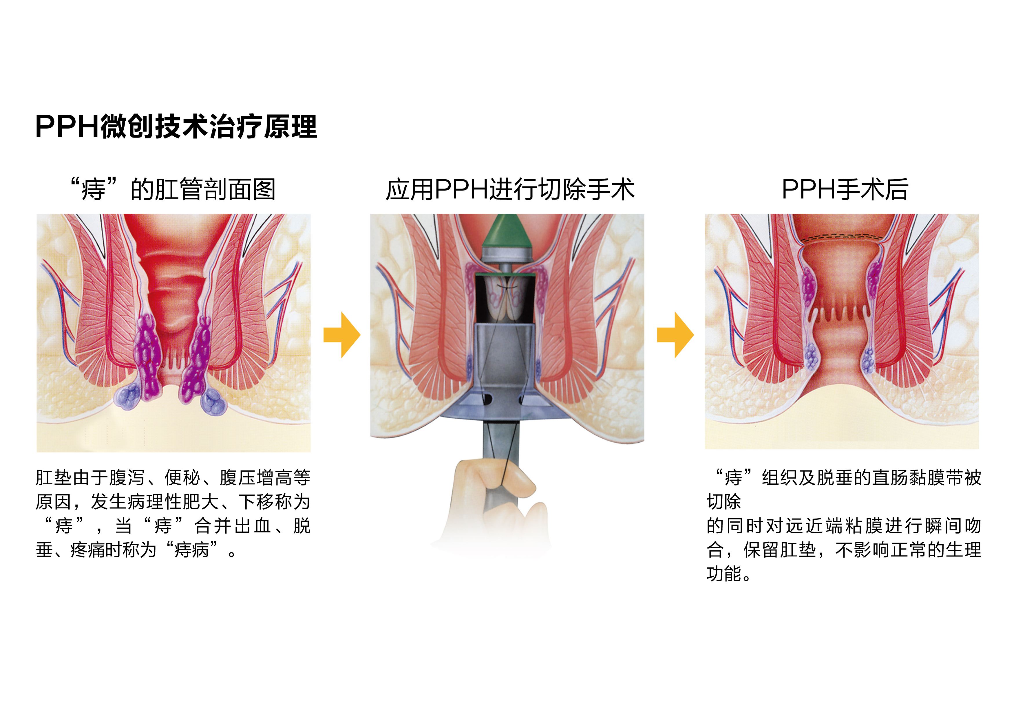 什么痔疮需要手术？有哪些治疗手段？一次性全都告诉你