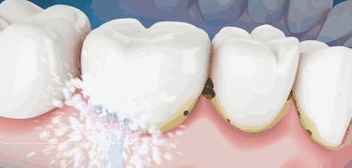 牙科拜拜，用它在家也能洗牙，每次不到2毛