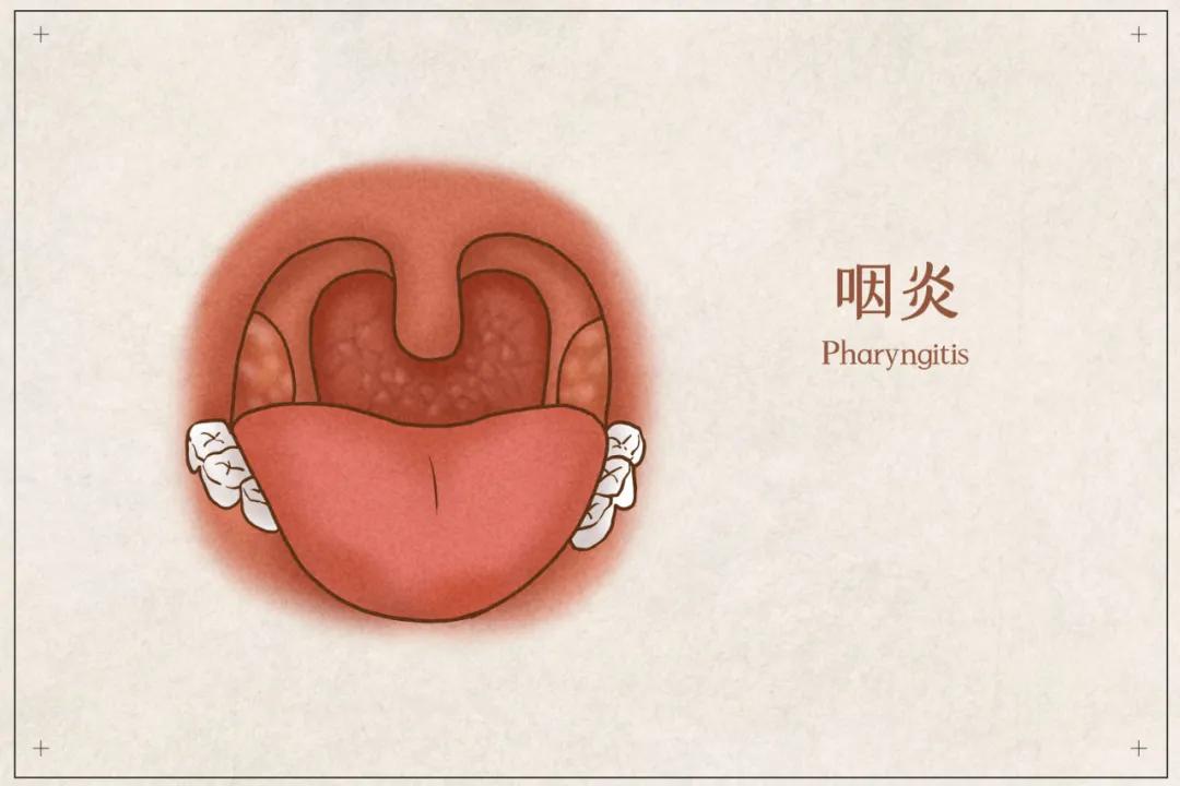 如鲠在喉，你是不是老觉得喉咙里有痰，咯不上来，又咽不下去？