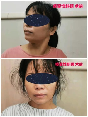 中国十大专业治疗斜颈（含落枕）的权威医院推荐