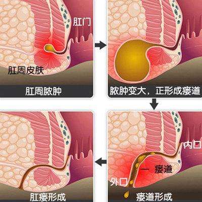 屁股上长了一个小洞，还流脓水，是得了肛瘘吗？