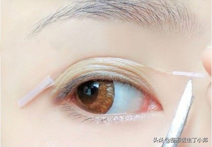 肿眼泡可以这样解决 眼皮松弛也能提拉紧致