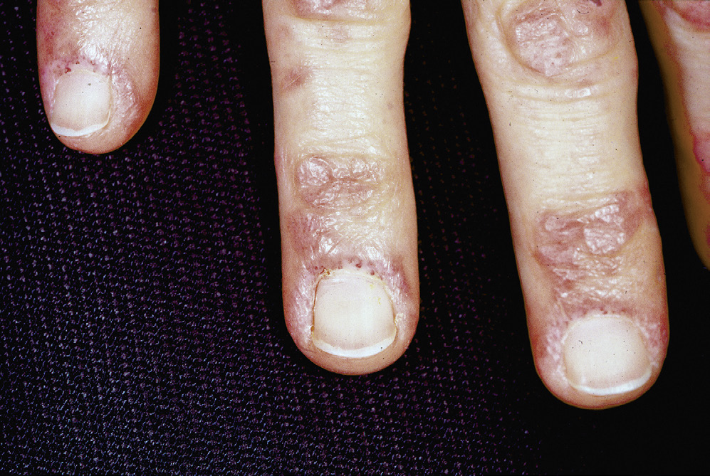 皮肌炎有什么样的皮肤改变?(1)