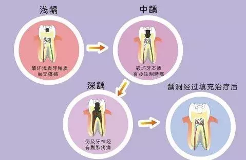 补牙价格差异如此巨大，你不知道的补牙“秘密”全都在这里！