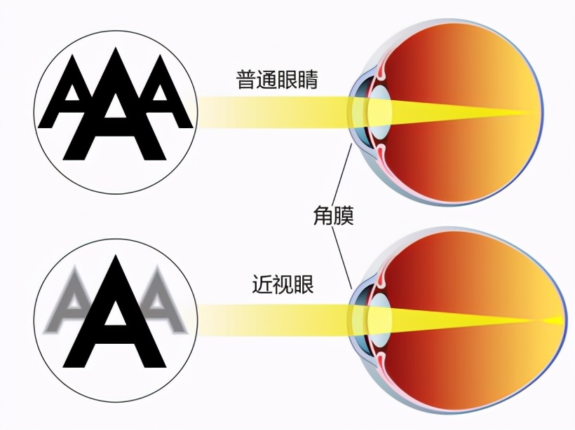 关于“近视激光手术”，这些利弊你知道吗？一文给你讲清楚