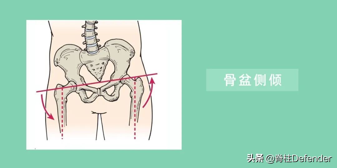 高低肩，怎样科学矫正？