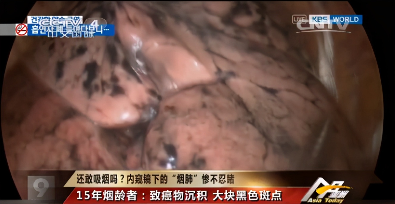 戒烟后,肺部还能恢复健康吗?