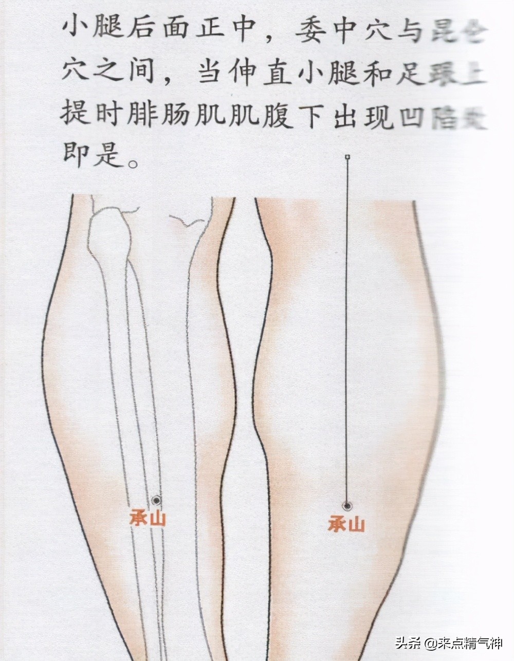 按揉百会、会阳、长强、承山穴，提肛运动治疗痔疮