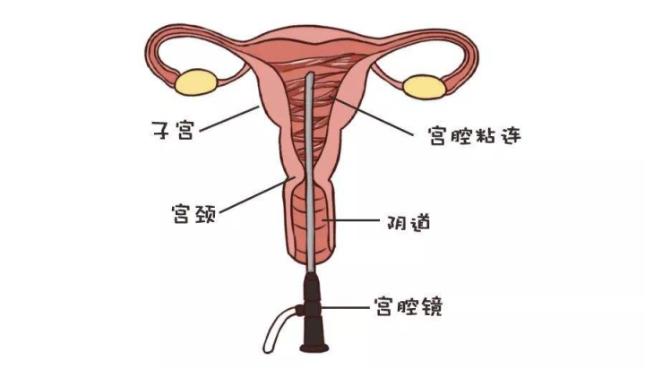 宫腔粘连能试管婴儿吗（宫腔粘连）