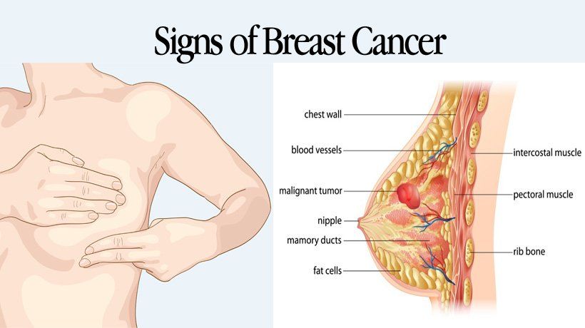 女人胸里摸到个小硬块，可能是乳腺癌吗？警惕这5种症状