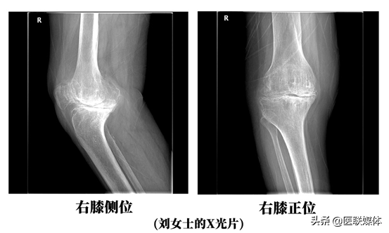 膝关节疼痛3年，查出来是骨性关节炎！该选择保守还是手术治疗？