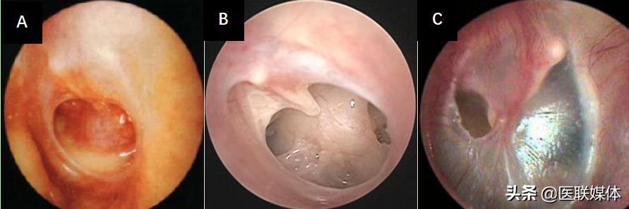 耳朵流水,流脓是什么回事?