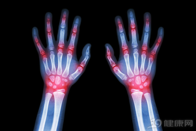 痛风难忍，该怎么治？这3个方法，医生也认同